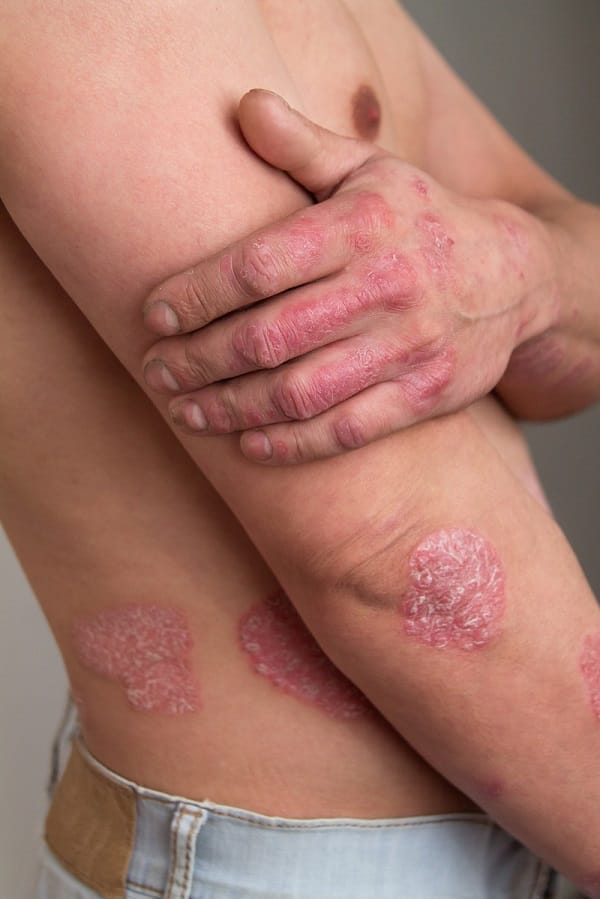 the man on the arm and abdomen psoriasis