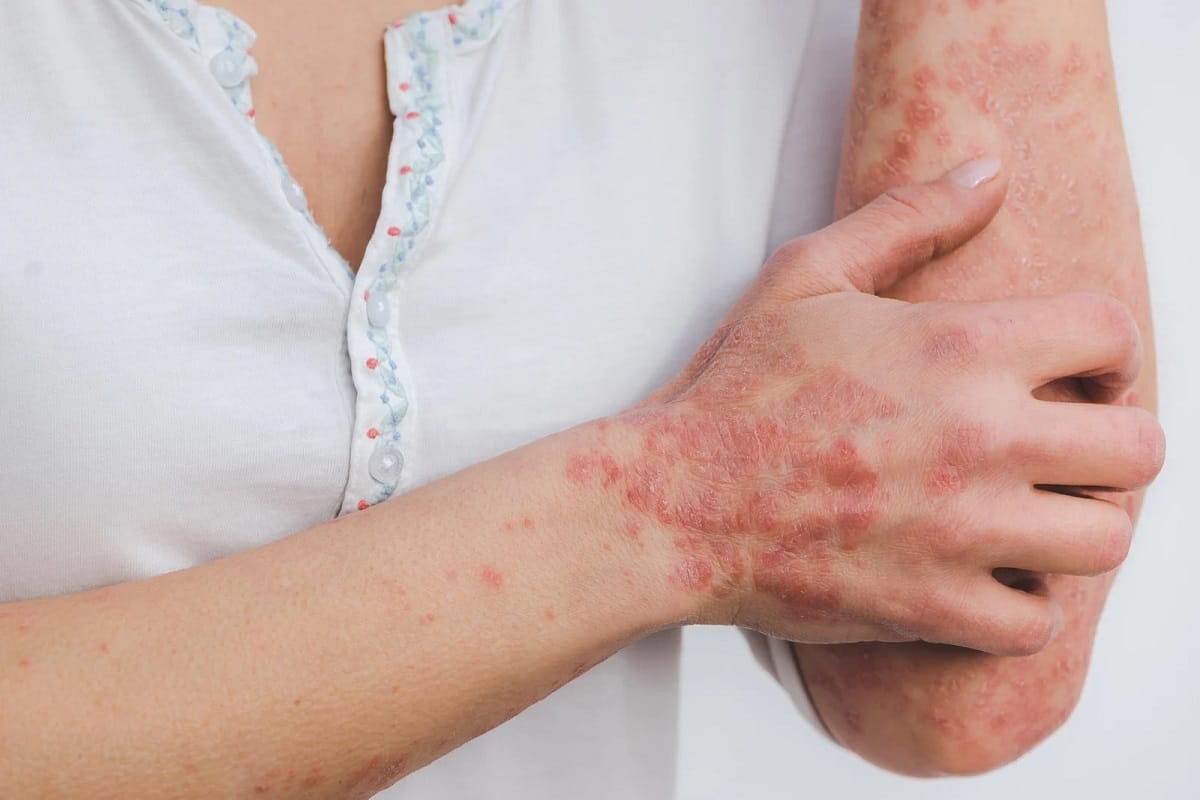 Psoriasis - SaiAyush Ayurveda Hospital - Hyderabad