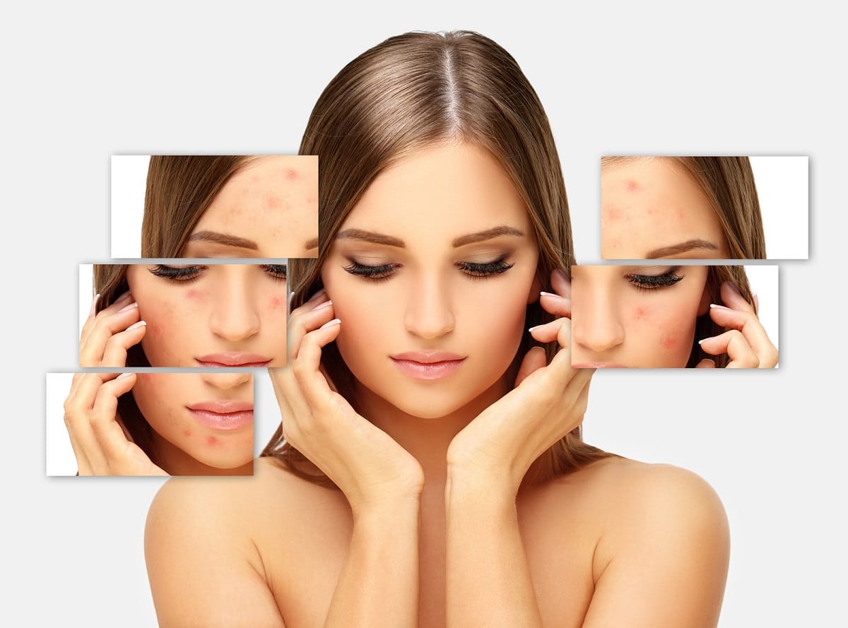 Post-Acne Marks,Acne Scars