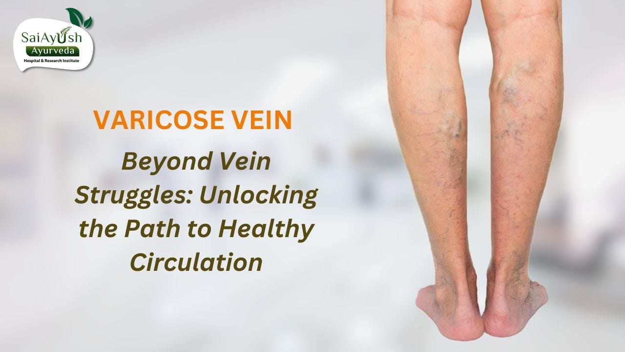 Natural Solutions for Varicose Veins: Ayurvedic Remedies and Management