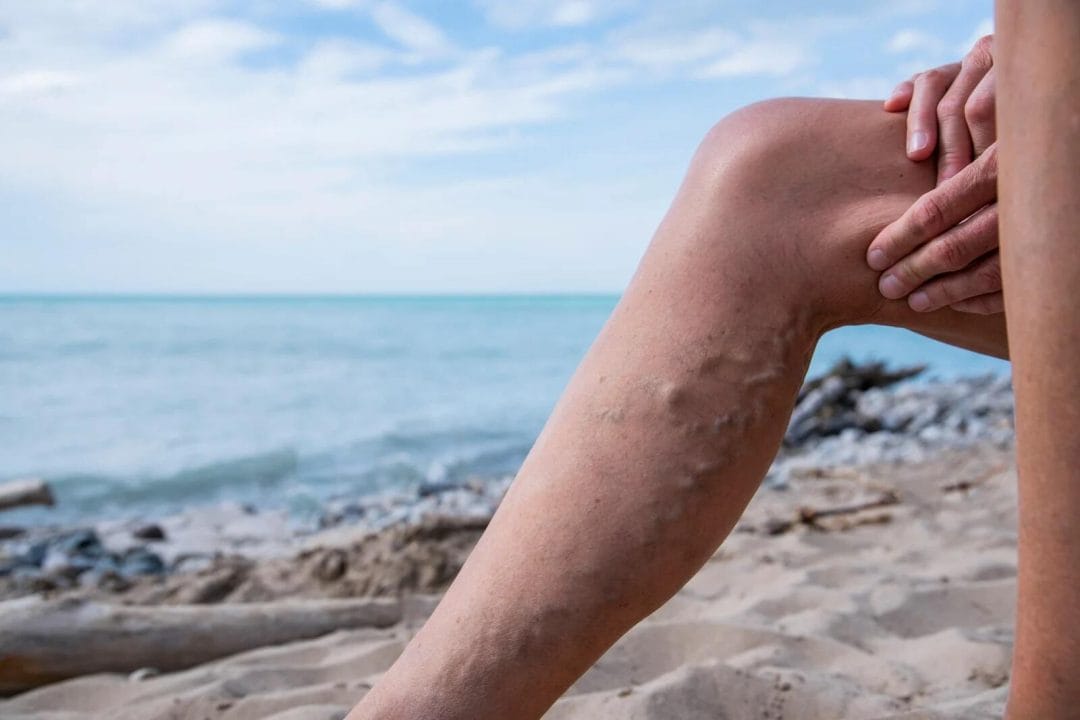 Varicose Veins3